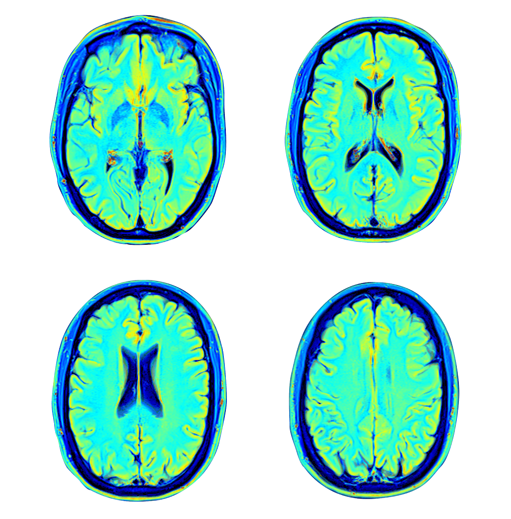 image of Fibromyalgia Symptoms Originate in the Brain